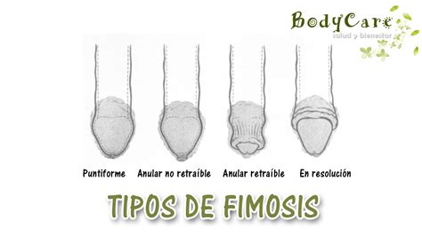 fimosis imagenes|Fimosis: cuándo operar, tipos, síntomas y postoperatorio